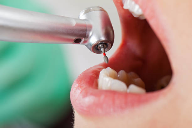 Best Emergency Wisdom Teeth Removal in Drumright, OK